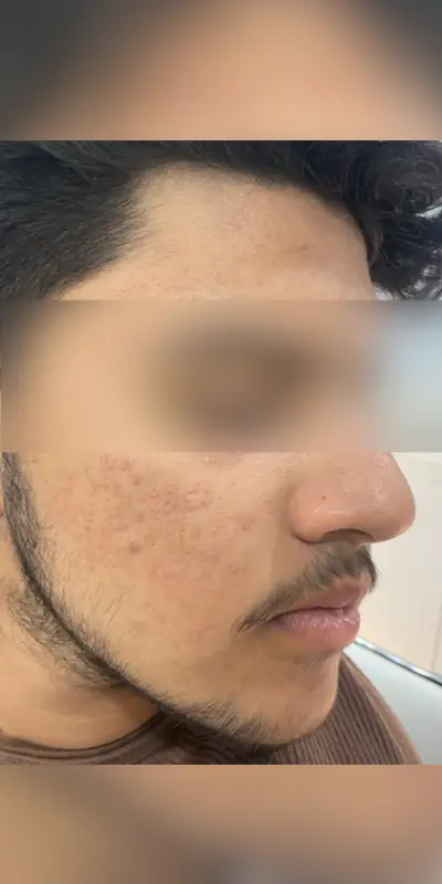 Glowing skin after HydraFacial treatment