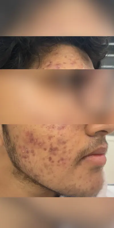 Dull skin pigmentation before treatment Bangalore