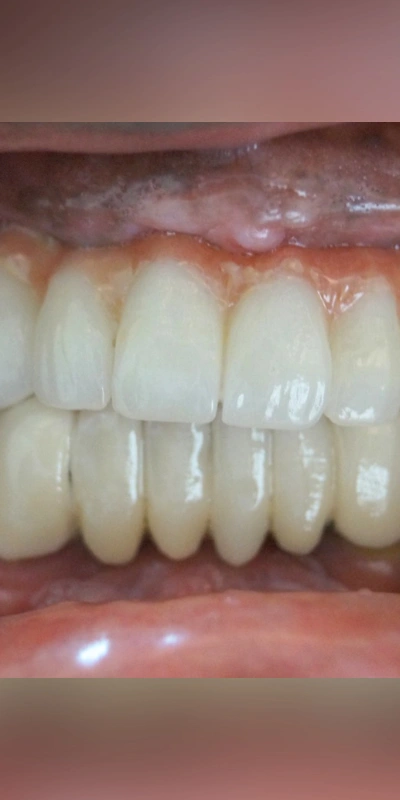Bright white teeth after teeth whitening