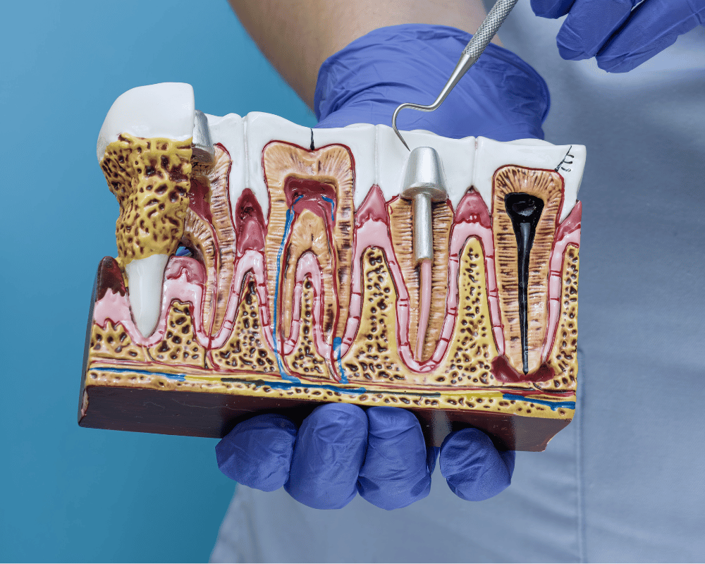 Post and Core Treatment in Bangalore at PRALASH