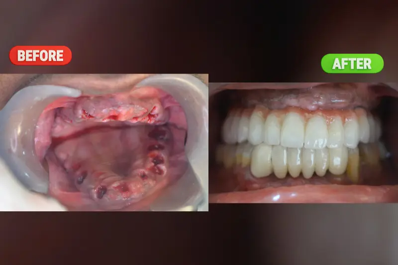 Full Mouth Rehabilitation Bangalore