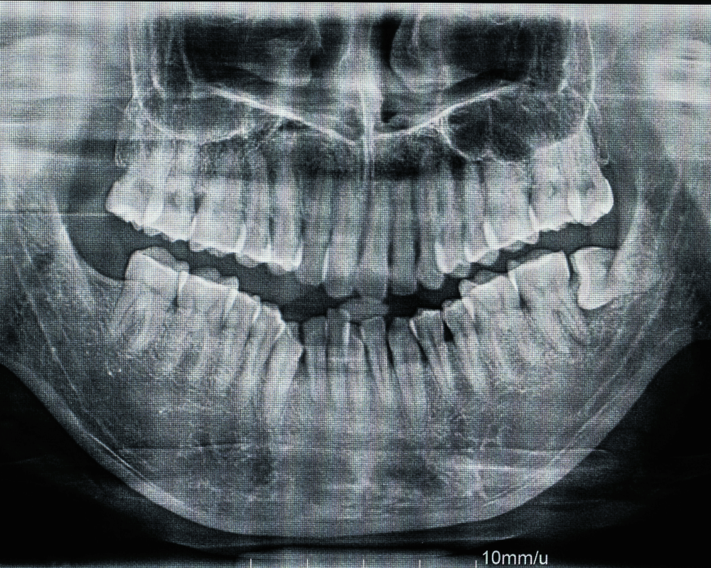 Digital RVG X-ray dental imaging in Bangalore at PRALASH