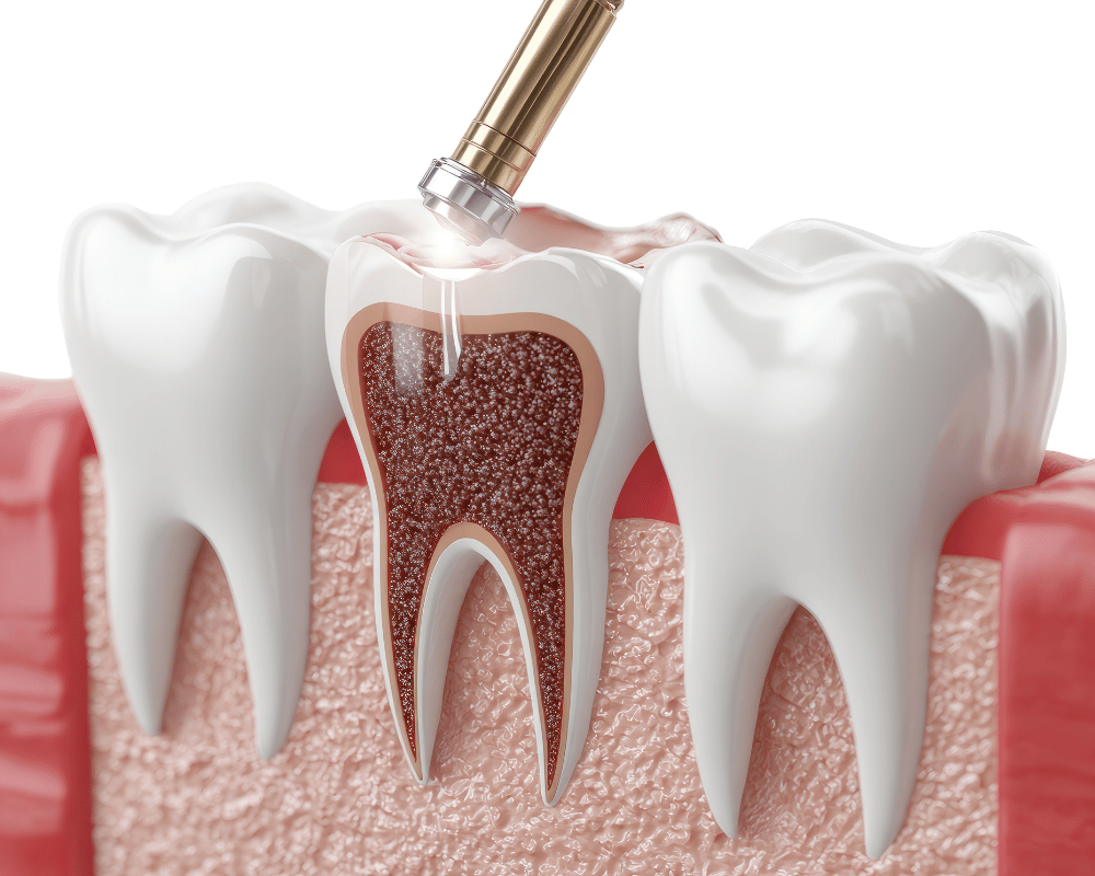 Flap and regenerative periodontal treatment in Bangalore at PRALASH