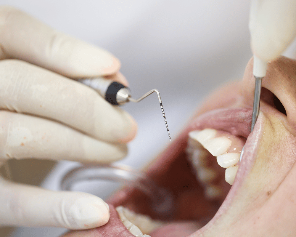 Non-surgical periodontal therapy in Bangalore at PRALASH