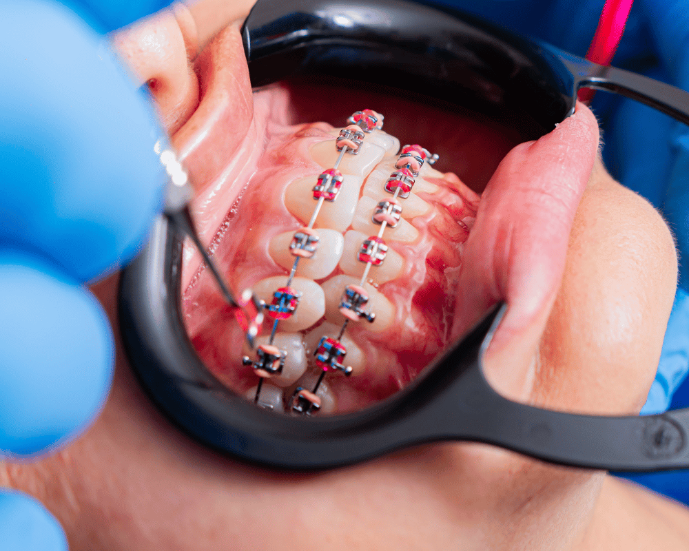 Minor orthodontic correction consultation in Bangalore at PRALASH