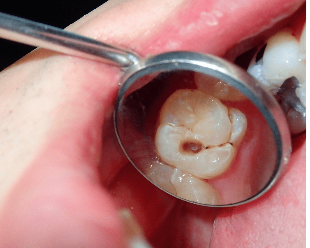 Pulpectomy Treatment Bangalore