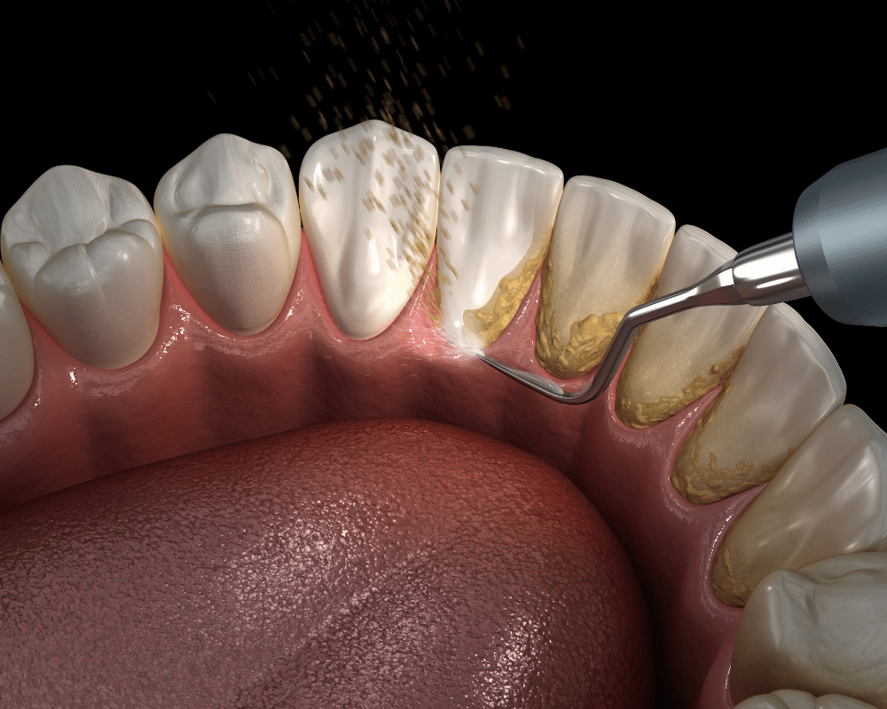 Dental cleaning procedure in HRBR Layout