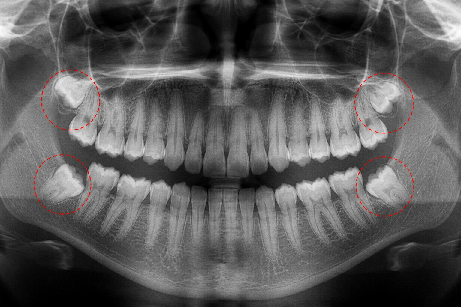 Wisdom Tooth Removal Bangalore