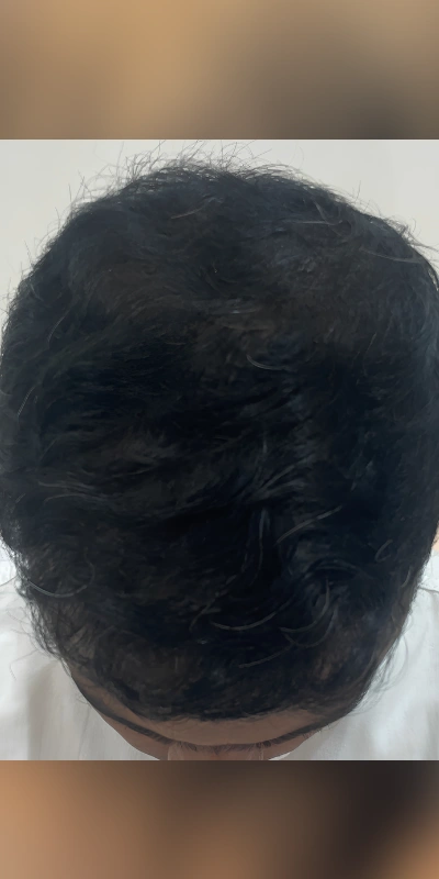 Full hair after PRP GFC treatment