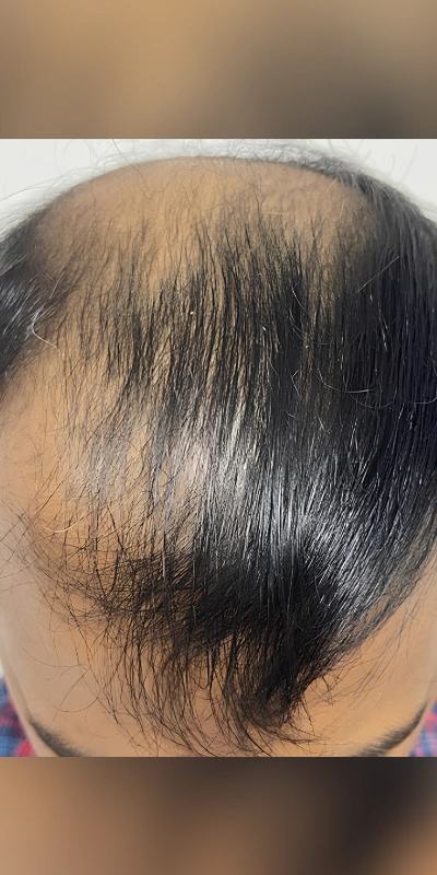 Hair loss before treatment Bangalore