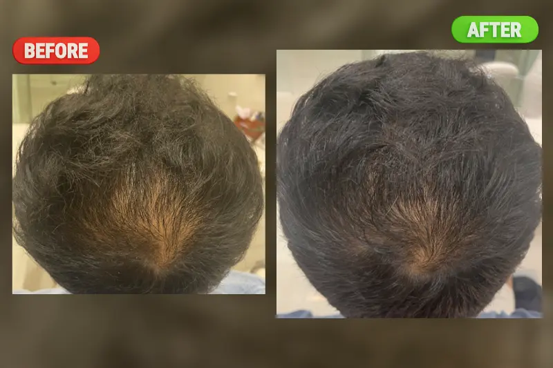 GFC Hair Treatment in Bangalore at PRALASH