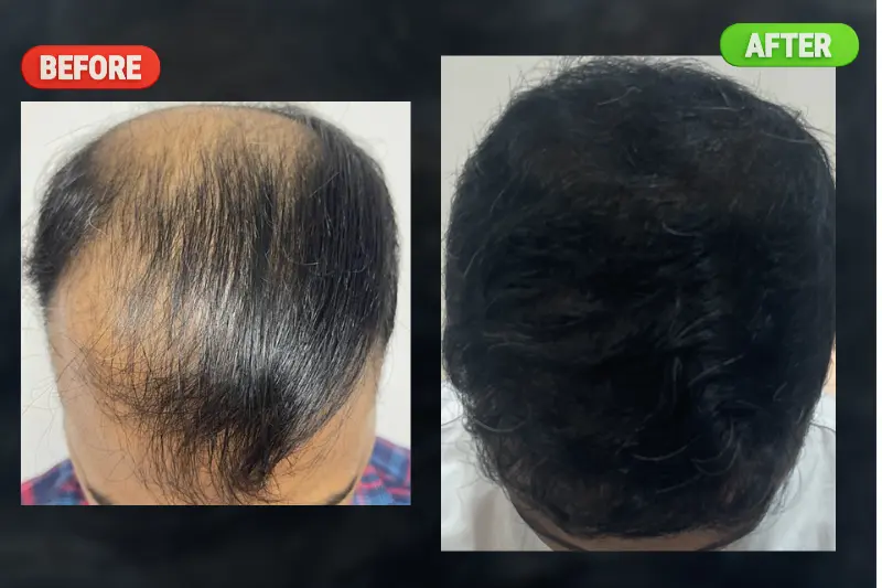 Hair Transplant FUE DHI in Bangalore at PRALASH