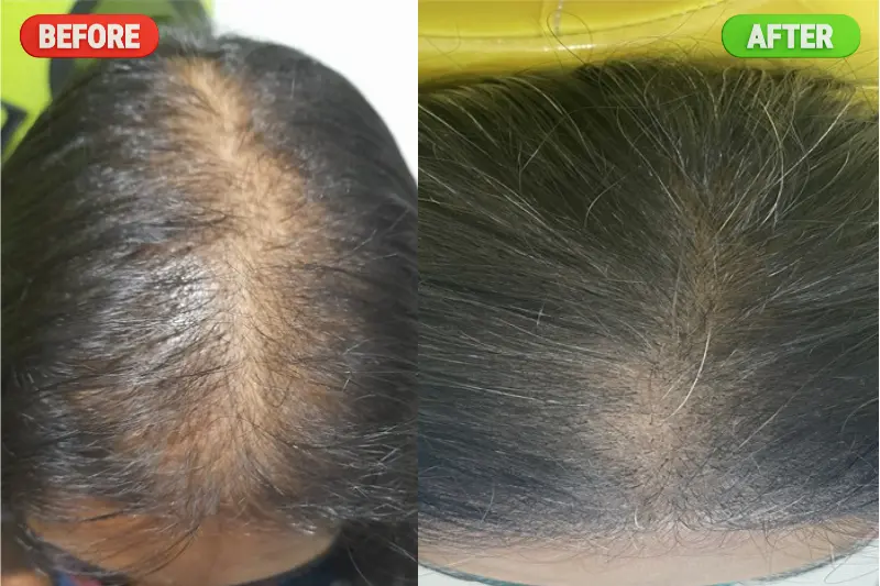 PRP Hair Treatment in Bangalore at PRALASH