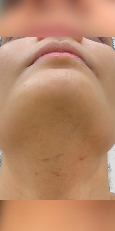 After result showing reduced facial hair on the chin and neck following laser hair removal treatment at PRALASH clinic in Bangalore