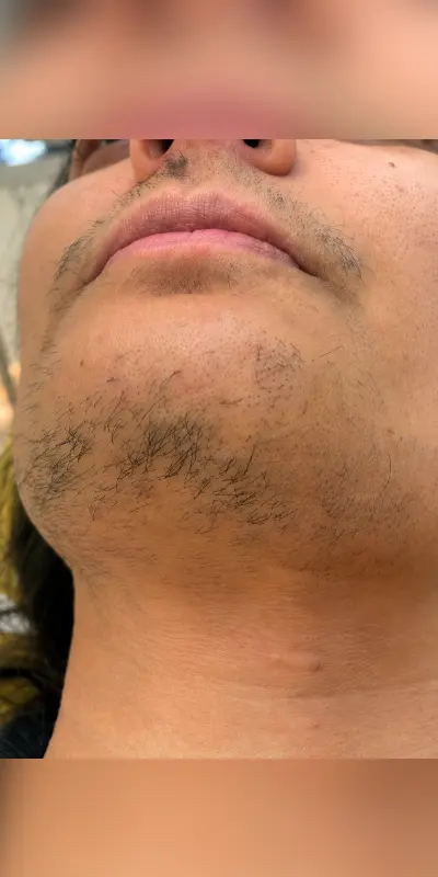 Before image showing visible facial hair on the chin and upper lip prior to laser hair removal treatment at PRALASH in HRBR Layout, Bangalore