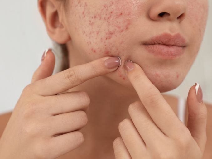 Acne scar classification and treatment planning at PRALASH HRBR Layout Bangalore