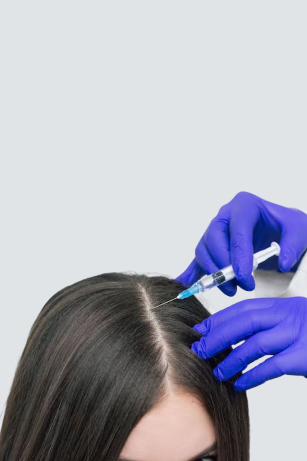 GFC hair treatment for improved hair density and healthier hair growth at PRALASH Clinic.