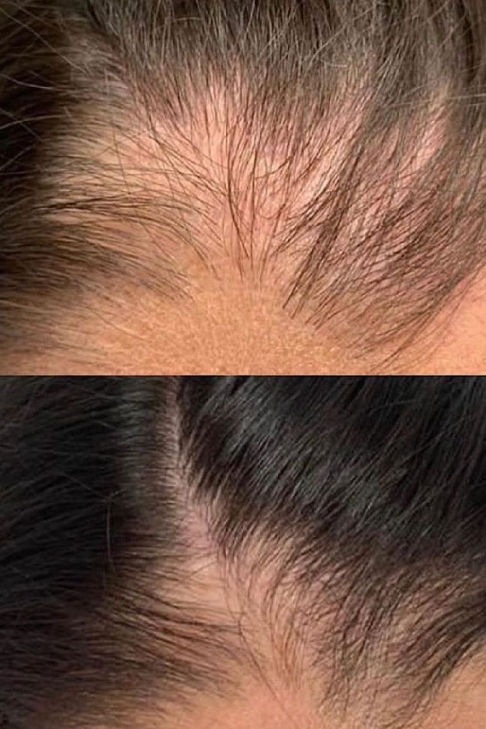 How GFC hair treatment works - growth factor concentrate process at PRALASH Bangalore