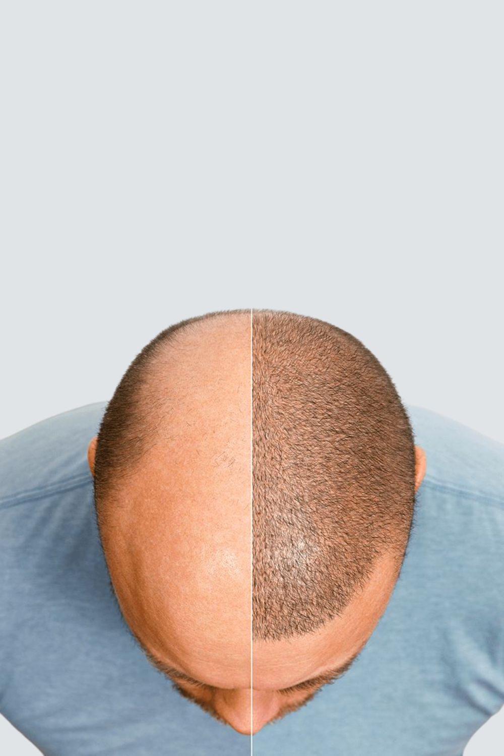 How hair transplant works - FUE process steps at PRALASH Bangalore