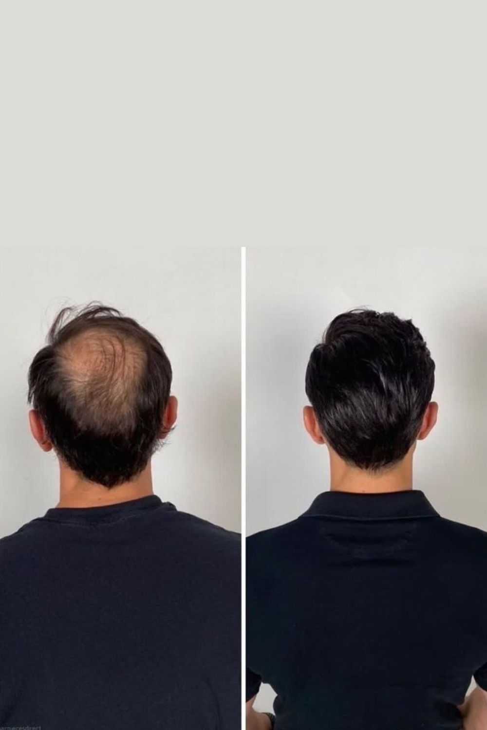 How PRP hair treatment works - process at PRALASH Bangalore