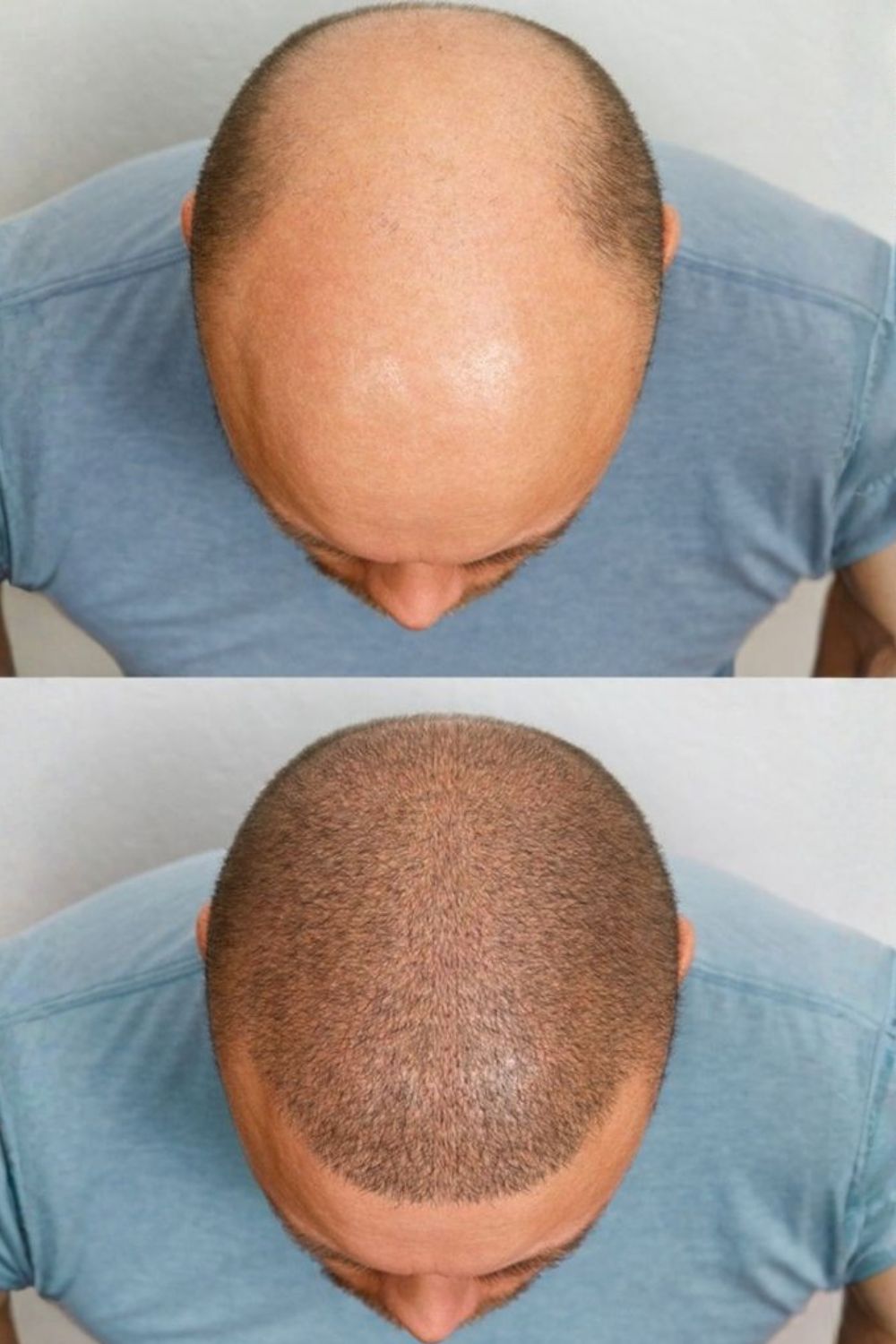 How Scalp Micropigmentation works - step by step SMP process at PRALASH Bangalore