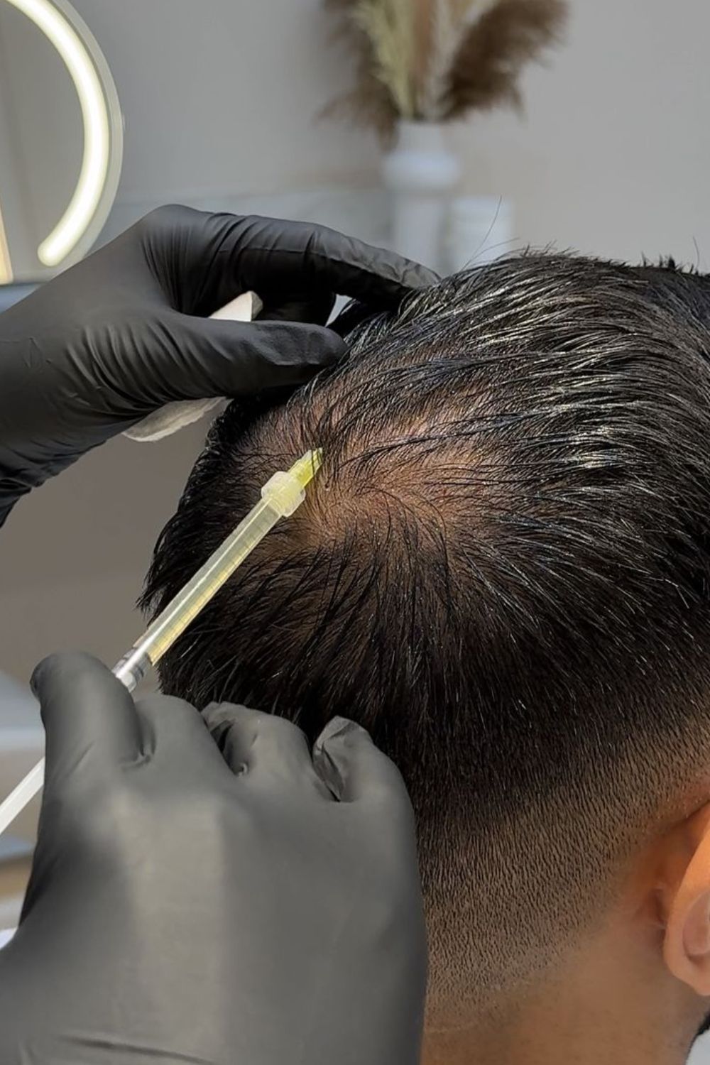 PRP hair treatment for reduced hair thinning and improved hair density at PRALASH Clinic.