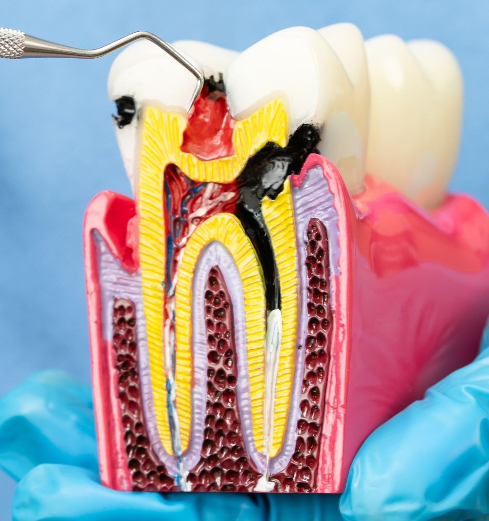 Painless root canal procedure in HRBR Layout
