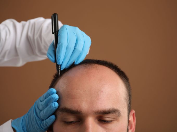 Scalp Micropigmentation (SMP) in Bangalore at PRALASH