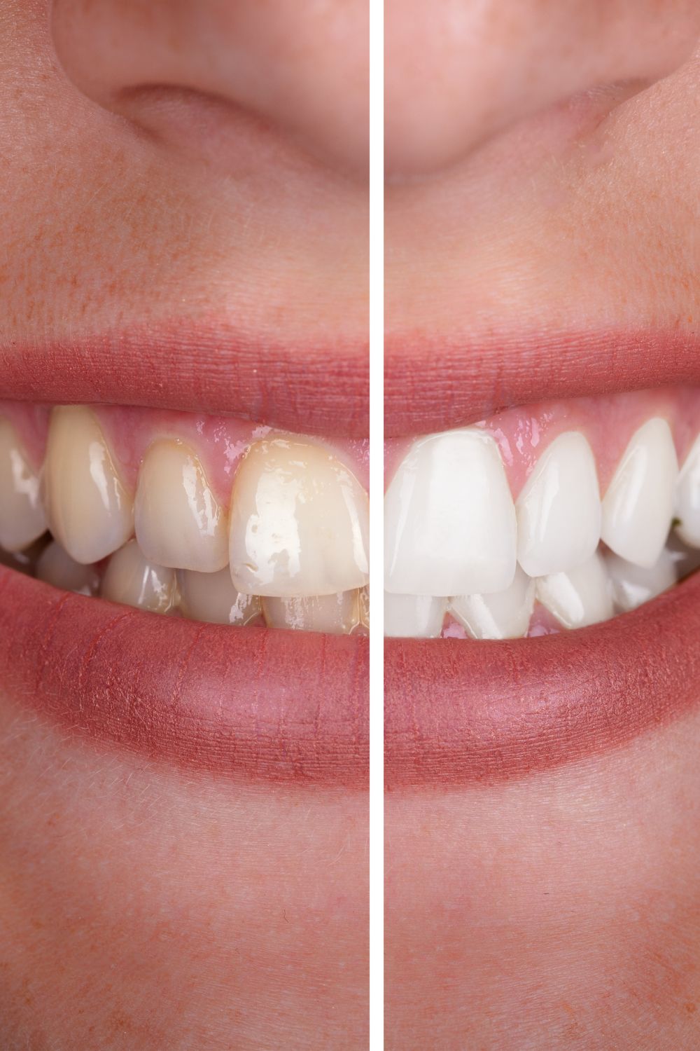 Professional teeth whitening procedure in HRBR Layout