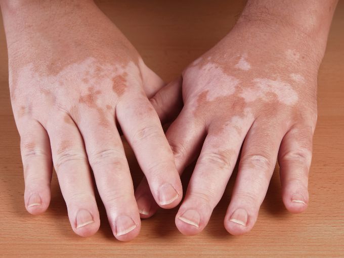 Vitiligo Surgery Bangalore PRALASH
