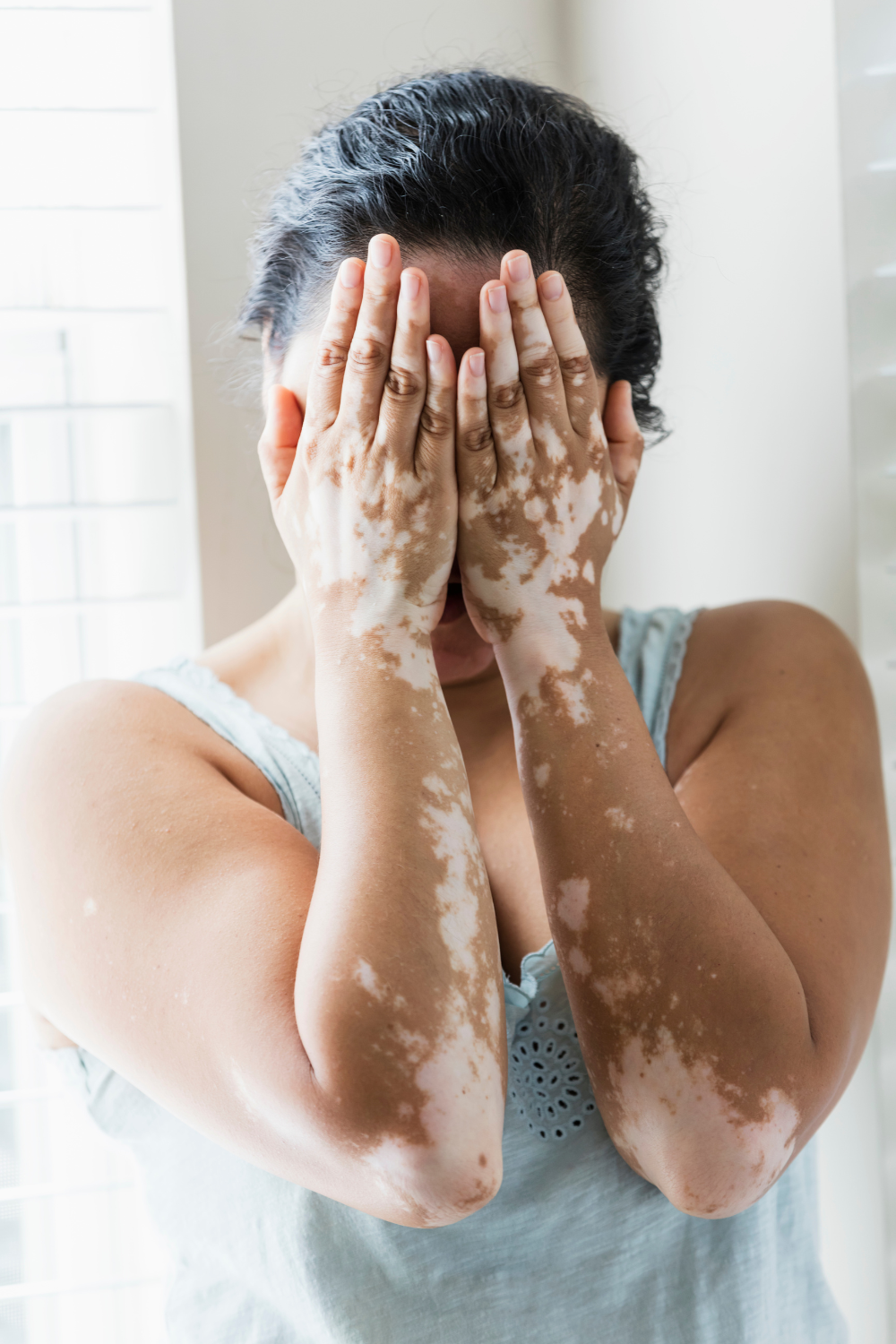 Vitiligo Surgery showing repigmentation of a stable vitiligo patch at PRALASH Clinic.