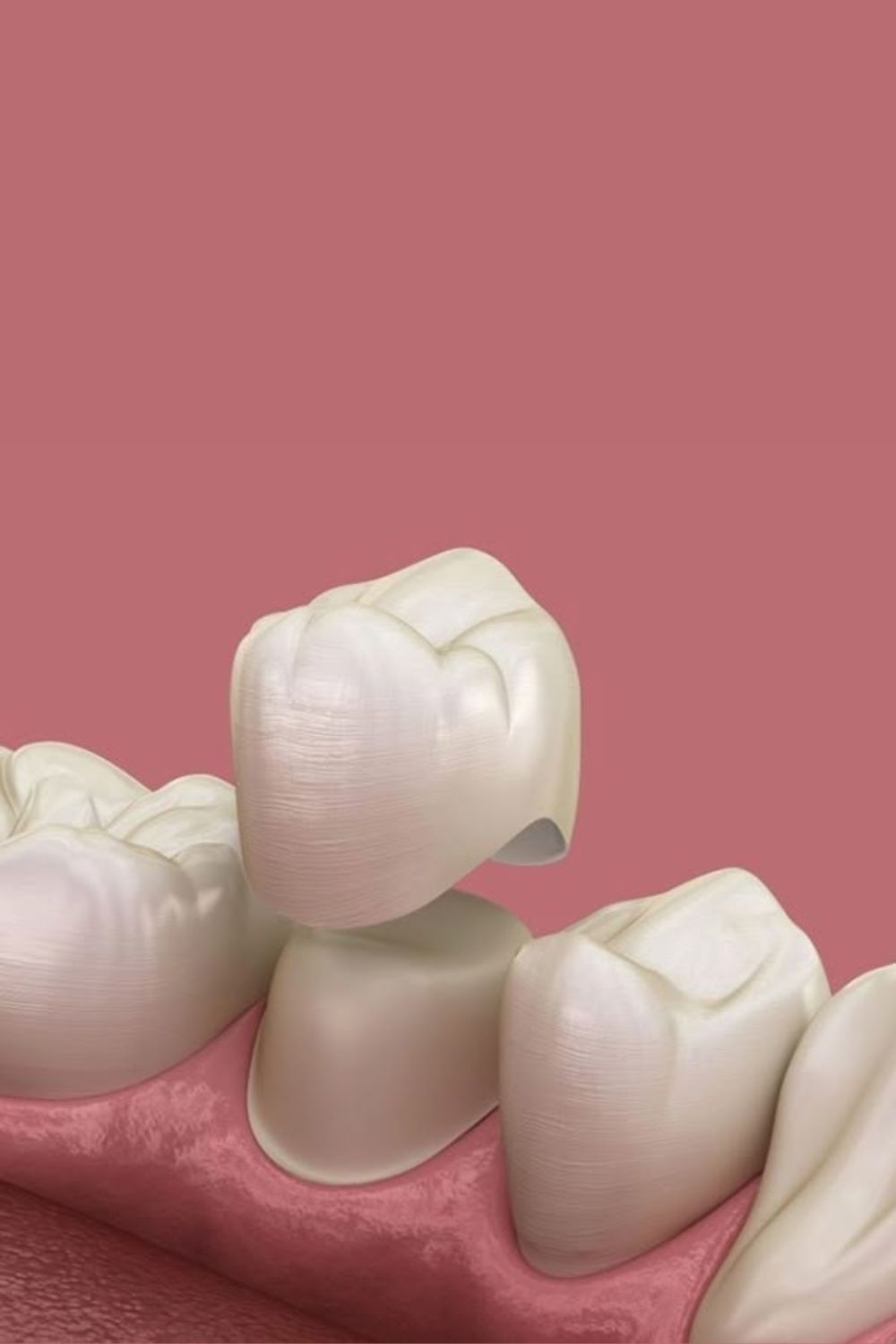 Dental Crowns in Bangalore at PRALASH