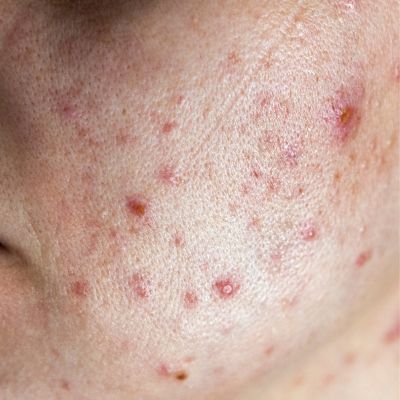Acne