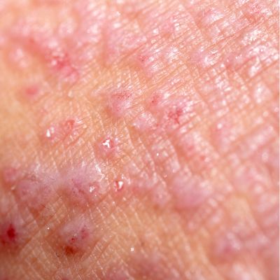 Eczema and dermatitis