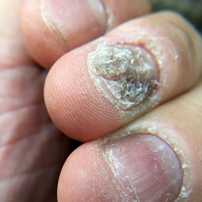 nail disorder
