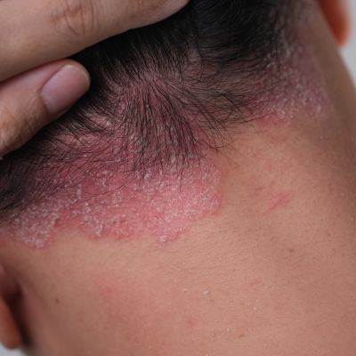 psoriasis