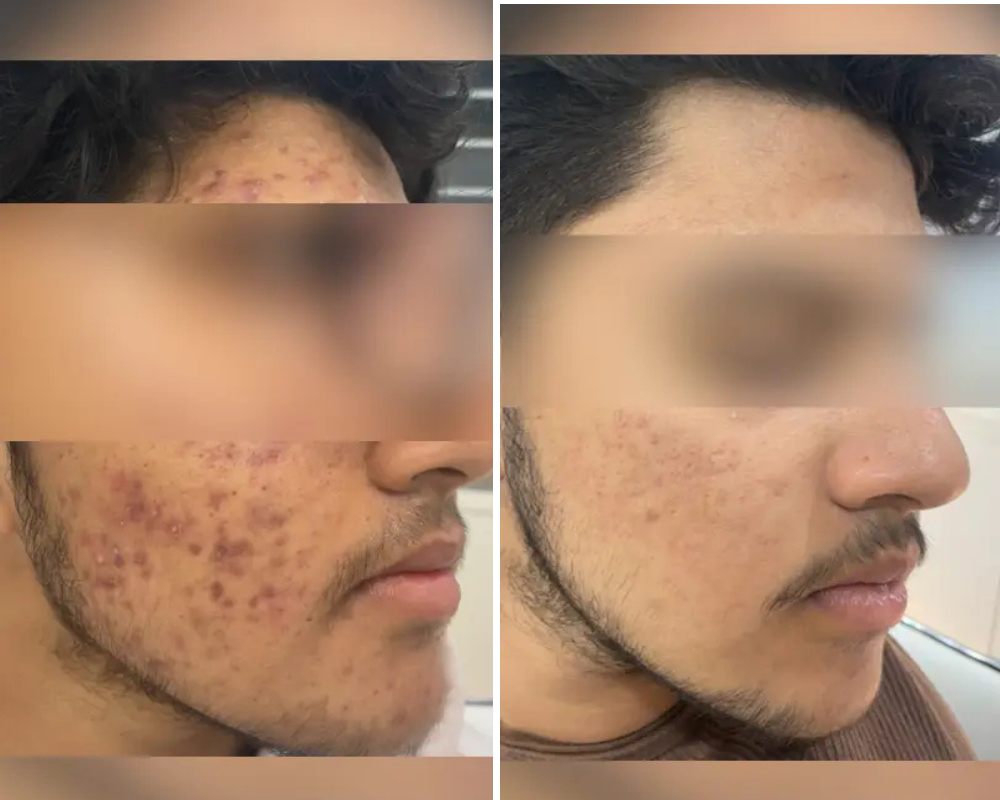 Acne Treatment Bangalore PRALASH
