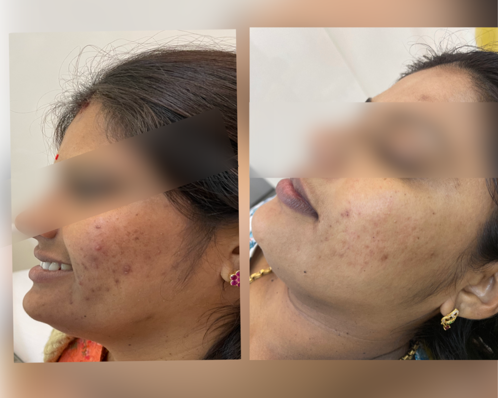 Chemical Peels Bangalore PRALASH