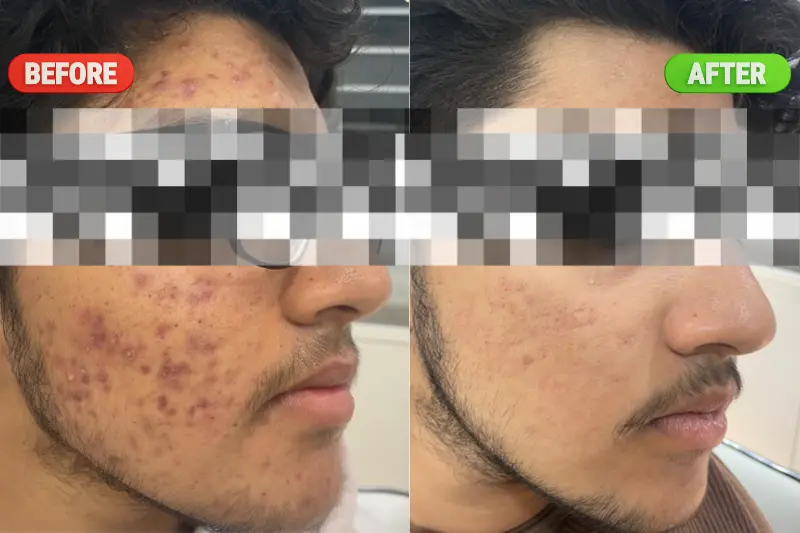 Before and after results of chemical peel treatment in Bangalore showing reduced pigmentation and smoother, more even skin tone at PRALASH Clinic.