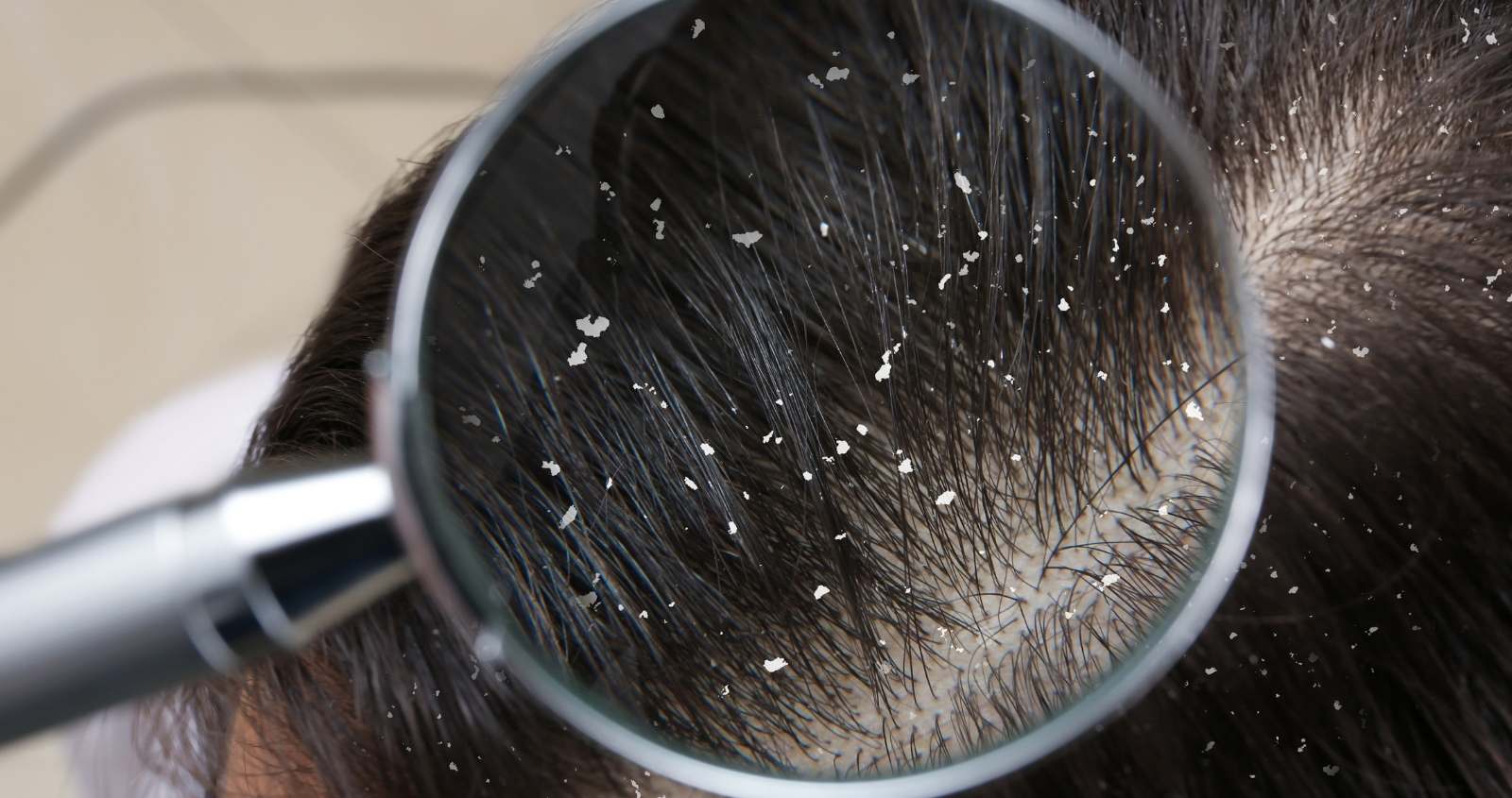 Dandruff scalp treatment process in Bangalore