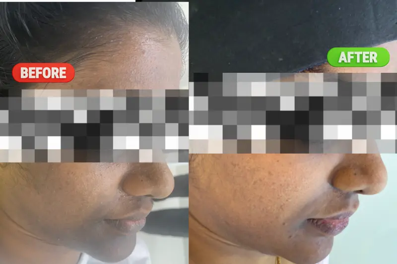 Before and after results of HydraFacial Treatment in Bangalore showing improved skin hydration, smoother texture, refined pores, and a healthy glow at PRALASH Clinic.