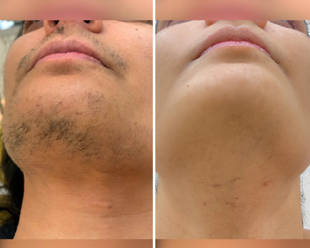 Laser hair removal treatment in Bangalore at PRALASH Clinic HRBR Layout