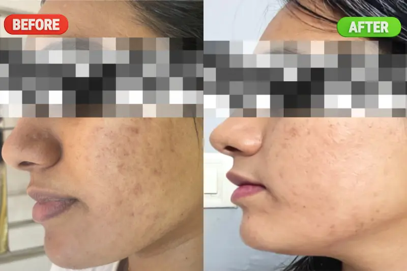 Before and after results of Microneedling Treatment in Bangalore showing visible improvement in acne scars, skin texture, and smoother-looking skin at PRALASH Clinic.