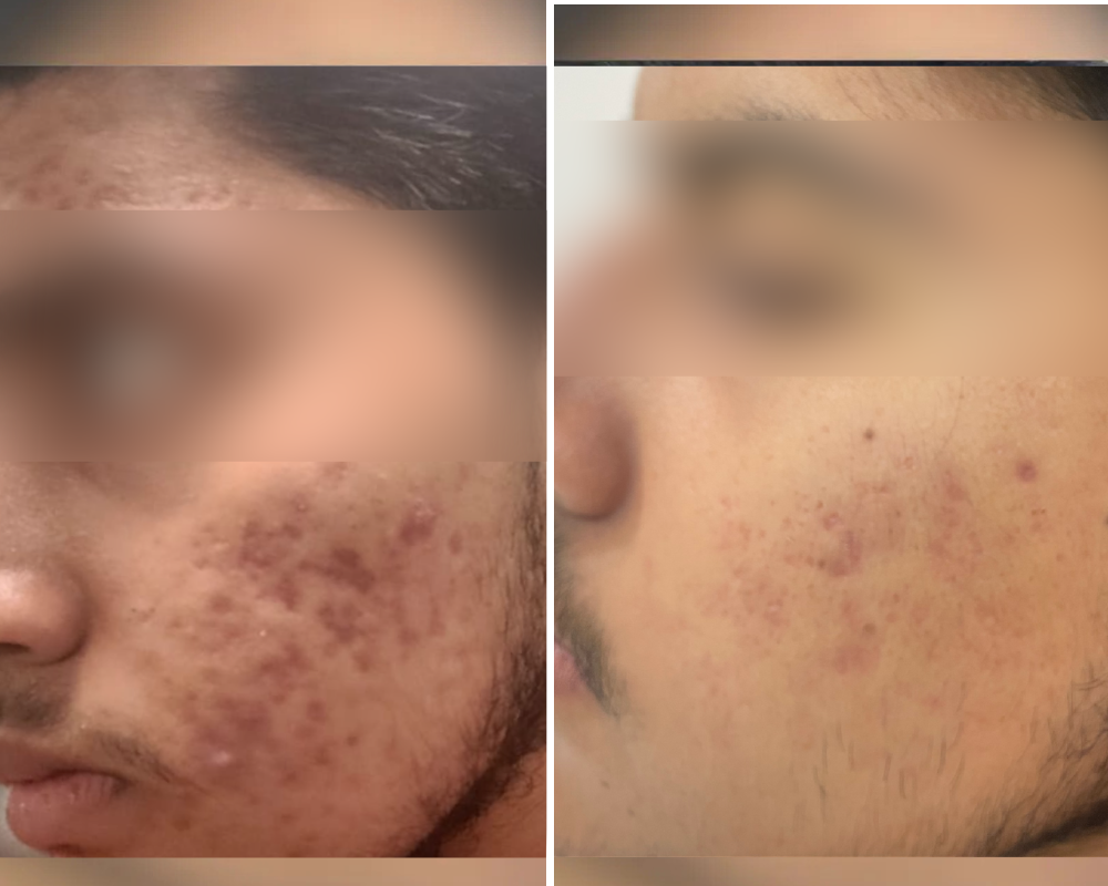 Microneedling Dermapen RF Bangalore PRALASH