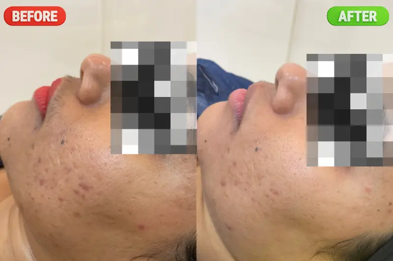 Pigmentation Treatment Bangalore PRALASH