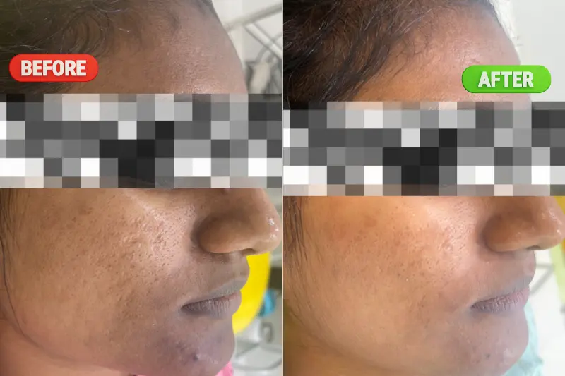 Before and after results of Skin Brightening Treatment in Bangalore showing improved skin tone, enhanced radiance, reduced pigmentation, and smoother skin at PRALASH Clinic.